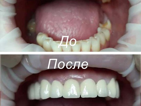 Фото стоматологии «Зуботехническая лаборатория, CAD/CAM» - Восстановление зубов с помощью культевых вкладок и мостовидного протеза из металлокерамики