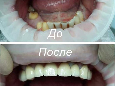 Фото стоматологии «Зуботехническая лаборатория, CAD/CAM» - Восстановление зубов с помощью мостовидного протеза из металлокерамики