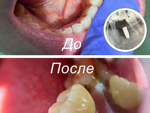 Фото стоматологии «Зуботехническая лаборатория, CAD/CAM» - Коронка на имплант из диоксида циркония