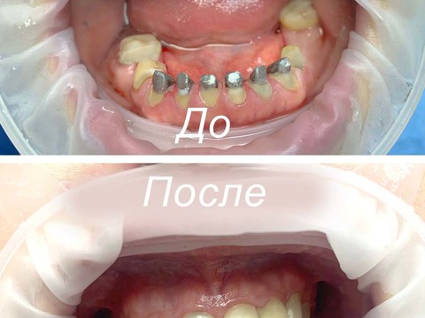 Фото стоматологии «Зуботехническая лаборатория, CAD/CAM» - Восстановление зубов с помощью культевых вкладок и временного протеза