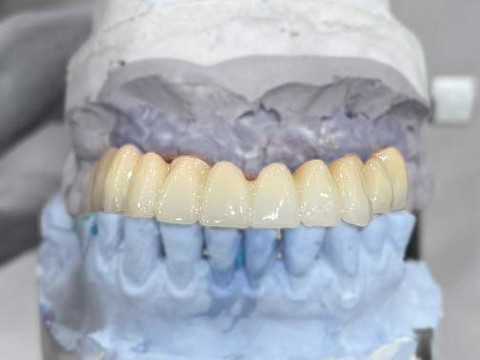 Фото стоматологии «Зуботехническая лаборатория, CAD/CAM» - Мостовидный протез из циркония