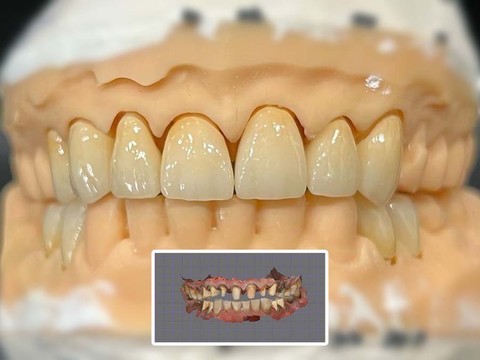 Фото стоматологии «Зуботехническая лаборатория, CAD/CAM» - Циркониевый протез с вестибулярным нанесение керамики. Отсканированная челюсть.