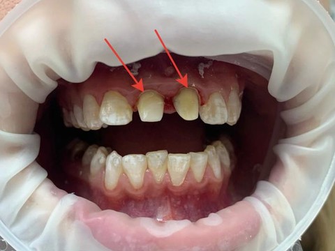 Фото стоматологии «Зуботехническая лаборатория, CAD/CAM» - Кильтевые вкладки (циркон), зафиксированные во рту