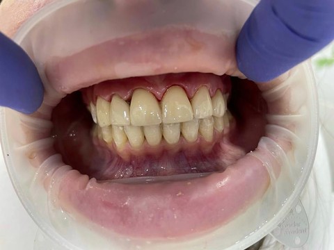 Фото стоматологии «Зуботехническая лаборатория, CAD/CAM» - Виниры E.max