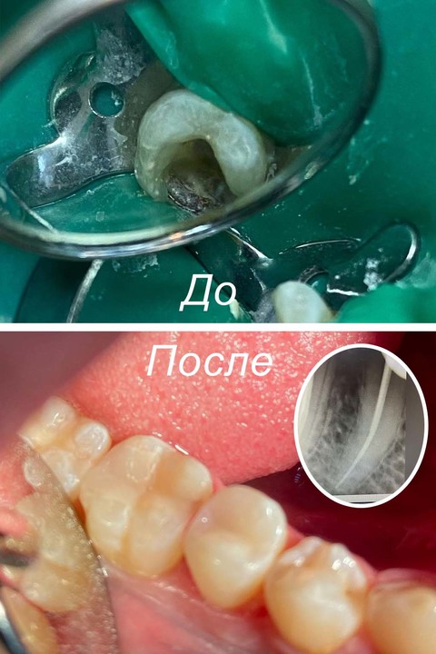 Фото работы врача «Егорочкина Анна Сергеевна» - Обработка корневого канала и восстановление анатомической формы зуба
