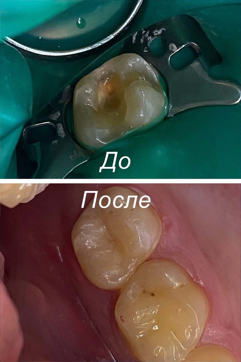 Фото работы врача «Егорочкина Анна Сергеевна» - Лечение кариса зуба 1.7