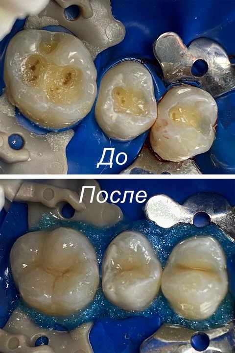 Фото работы врача «Егорочкина Анна Сергеевна» - Лечение кариса зуба 1.4, 1.5, 1.6. Восстановление анатомической формы
