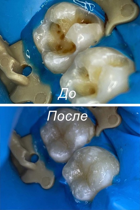 Фото работы врача «Егорочкина Анна Сергеевна» - Восстановление анатомической формы зуба 3.6 и 3.7