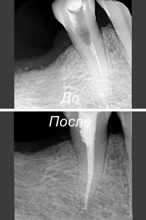 Фото работы врача «Лашкарадзе Георгий Придонович» - Перелечивание зуба со сломанным инструментом