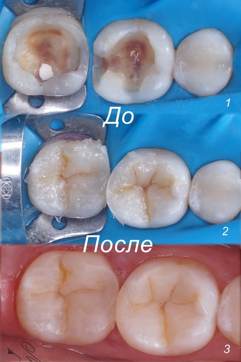 Фото работы врача «Лашкарадзе Георгий Придонович» - Реставрация зуба с соблюдением особенностей анатомии